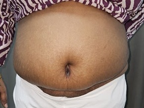 Body Contouring